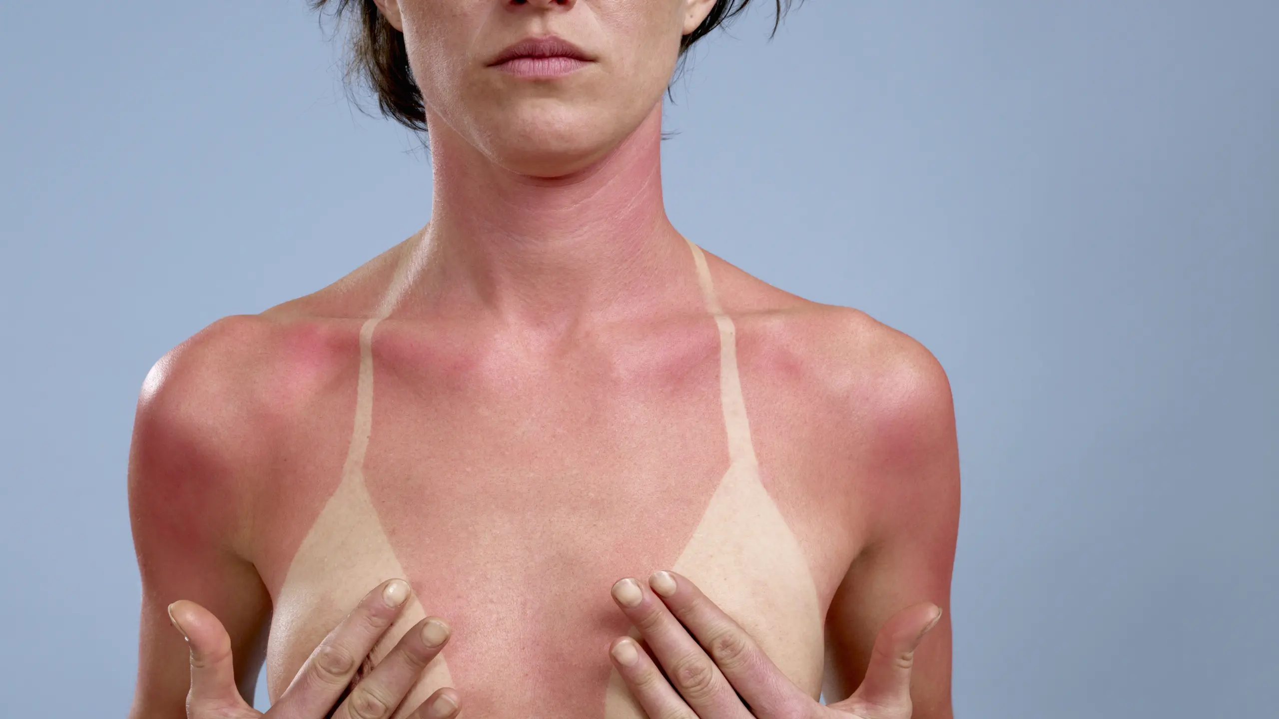 Sonnenflecken: Was tun gegen Melasma auf Haut und Gesicht?