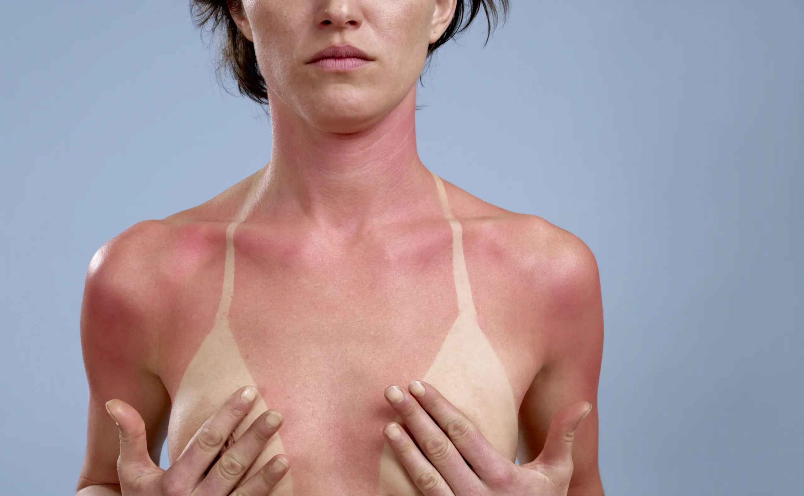 Sonnenflecken: Was tun gegen Melasma auf Haut und Gesicht?