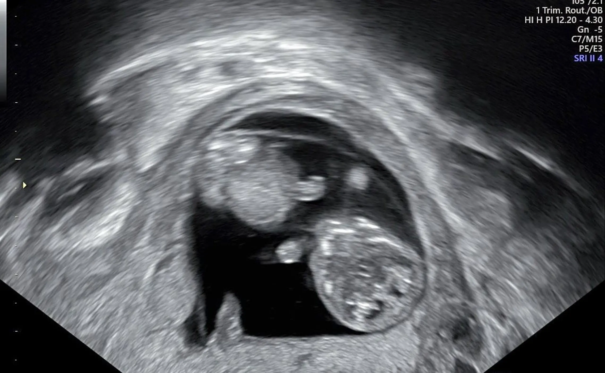 Schwangerschaftswochen - Ultraschall